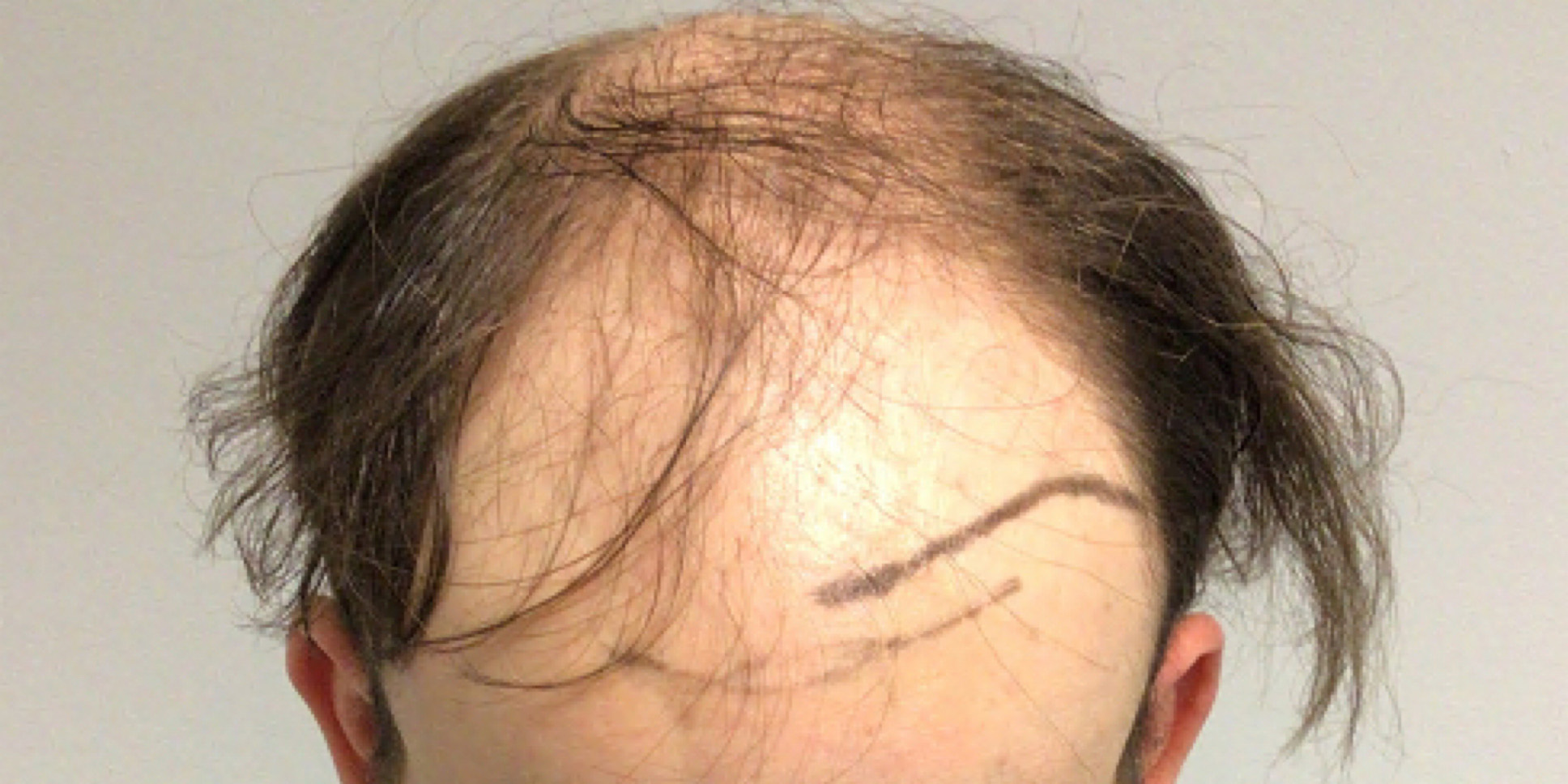 Hair Restoration for Men