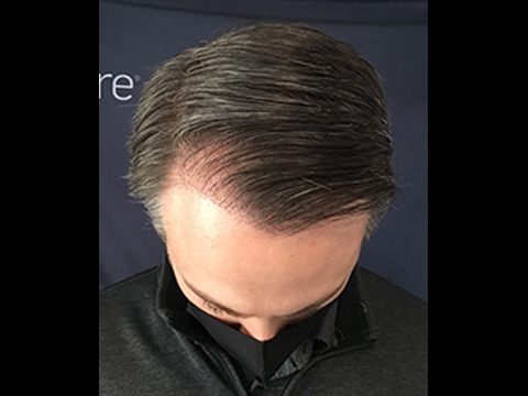 Almi Before and After | Michigan Hair Restoration